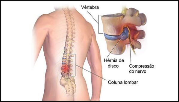 O Que H Rnia De Disco Quais As Causas Sintomas E Tratamento